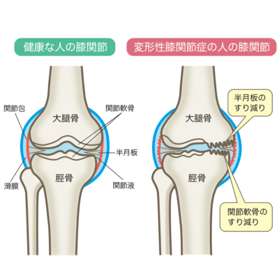 膝に水がたまる 福岡ひざ関節症クリニック スタッフブログ